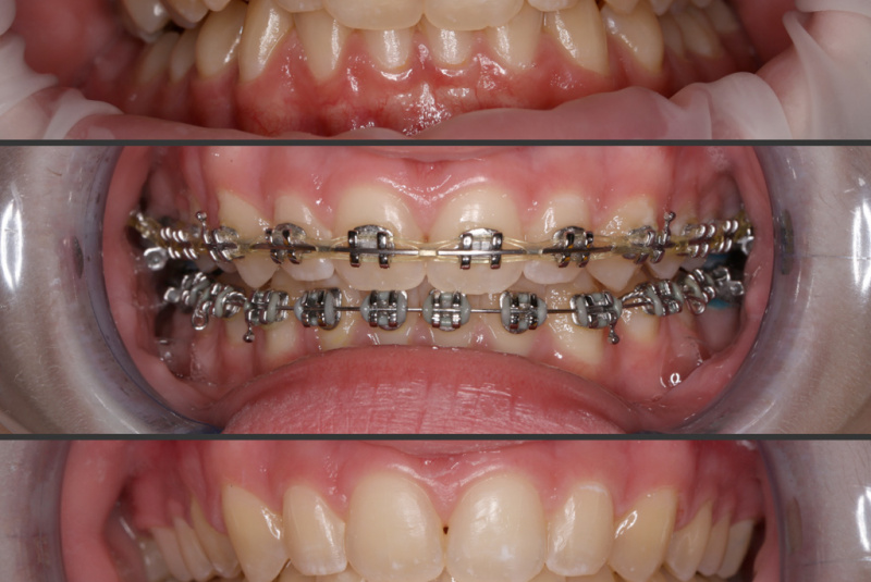  Premeny / Premeny so zubným strojčekom  - foto