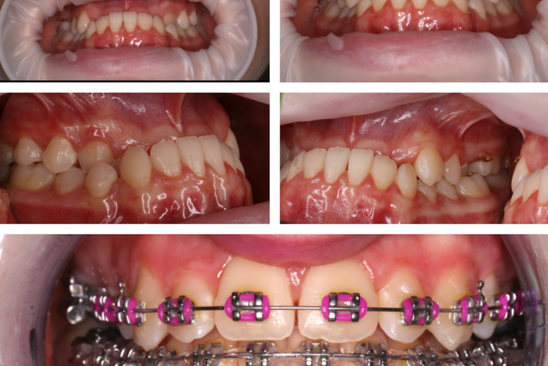  Premeny / Premeny so zubným strojčekom  - foto